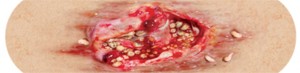 One of five designs: decubitus ulcer with maggot infestation. Photo: Sherwood Forlee
