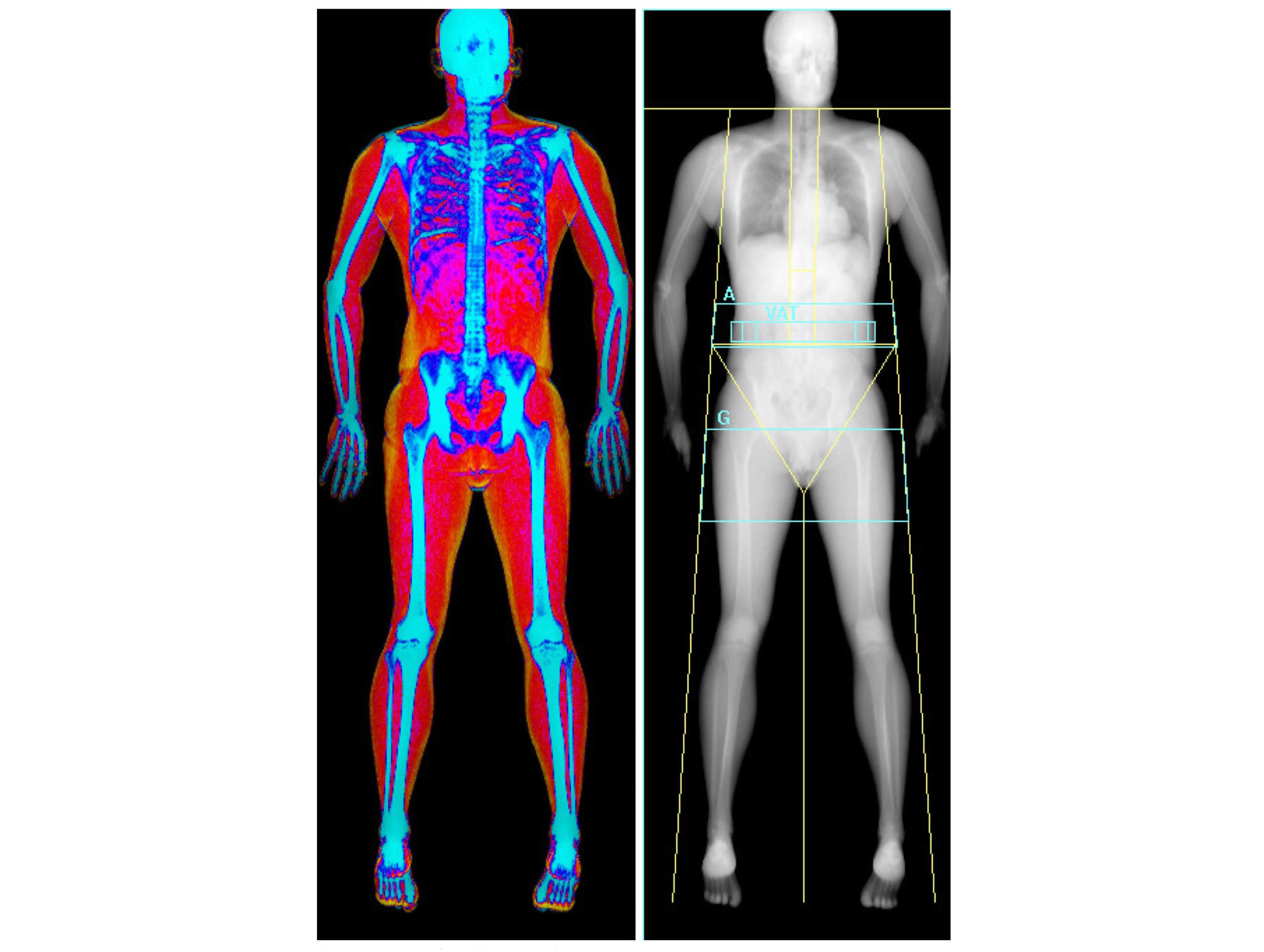 A DEXA scan makes your love handles light up in bright orange