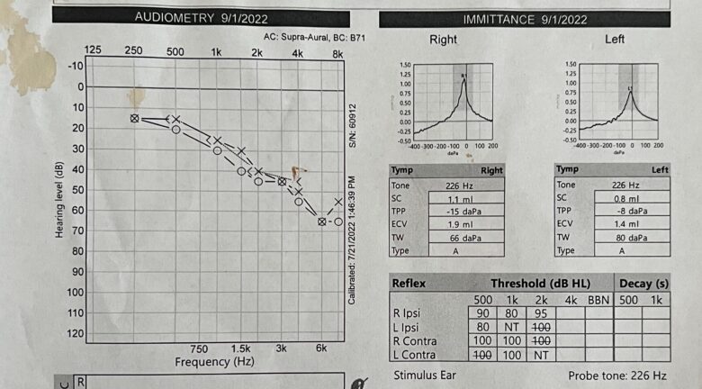 An audiogram showing hearing loss in the higher frequencies.